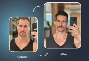 La greffe de cheveux en Turquie vaut-elle le coup ?