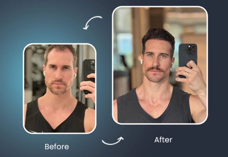 La greffe de cheveux en Turquie vaut-elle le coup ?